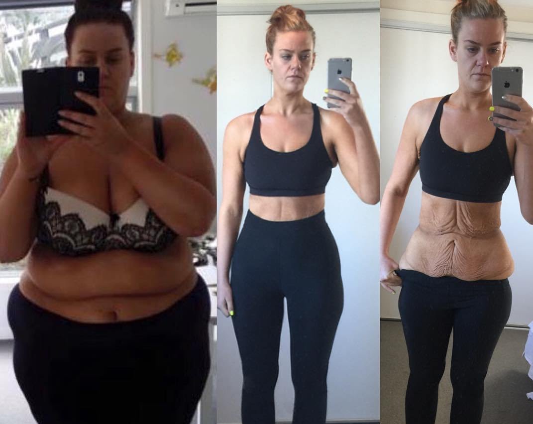 Woman accused of faking weight loss pics silences critics with one incredib...